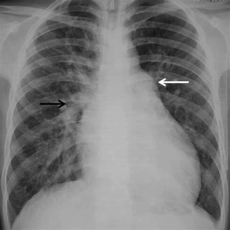 Chest X Ray Pa View Showing Cardiomegaly With Down And Out Apex Main