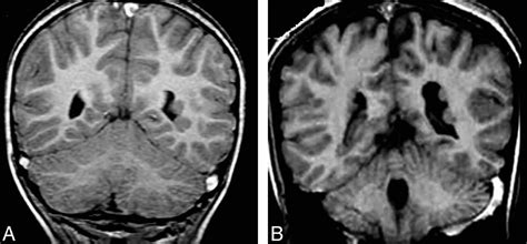 Gray Matter Heterotopia Causes Symptoms Diagnosis Treatment Prognosis