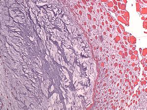 Intramuscular myxoma - Libre Pathology