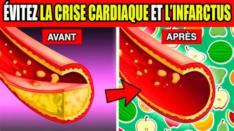 Comment Nettoyer les artères et Prévenir les crises cardiaques 8