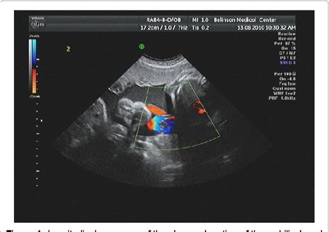 Figure 1 From Prenatal Diagnosis Of A True Knot Of The Umbilical Cord