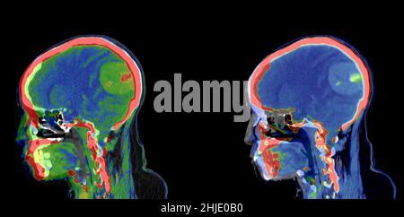 Benigna Tumore Al Cervello Colorato La Tomografia Computerizzata CT