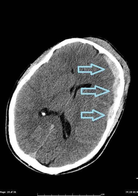 Subdural hematoma CT - wikidoc