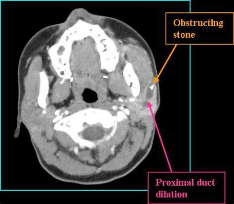 Sialolithiasis - Radiology | Iowa Head and Neck Protocols