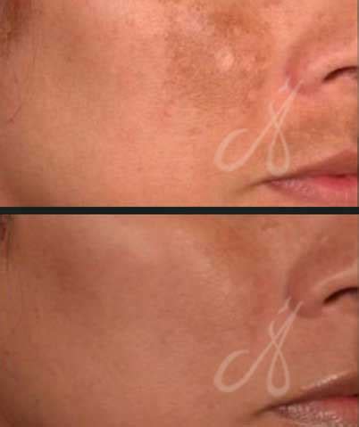 What is Carbon Peel Laser, Its Benefits, Side Effects, Cost and Aftercare.