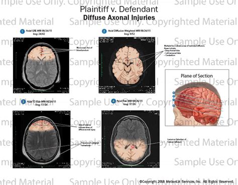 Diffuse Axonal Injuries - MotionLit