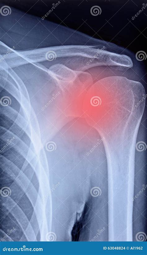 X Ray Shoulder Radiograph Stock Photography Cartoondealer