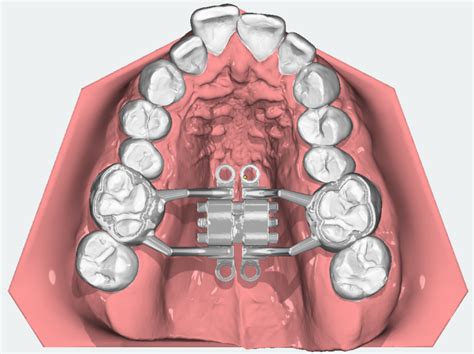 Efficacy Of Miniscrew Assisted Rapid Palatal Expansion MARPE In Late