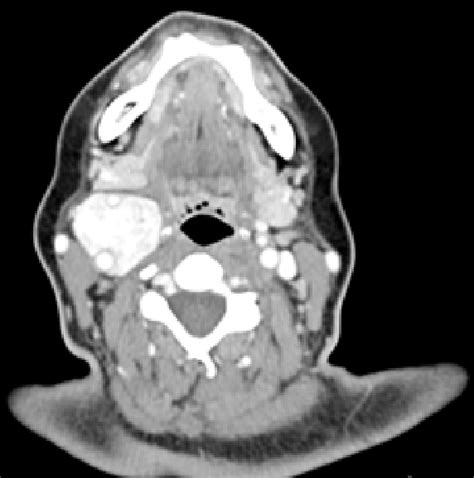 Axial Soft Tissue Window 2 Mm Slice Thickness Contrast Enhanced Ct