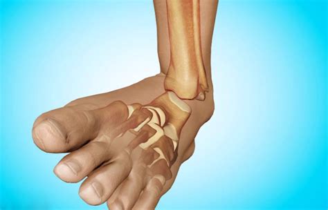 Вывих стопы: лечение в домашних условиях, причины