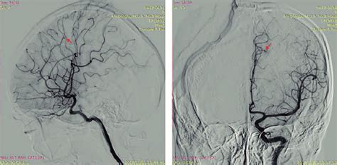 Cerebral Angiograms Showing Anterior Cerebral Arterymicroaneurysms