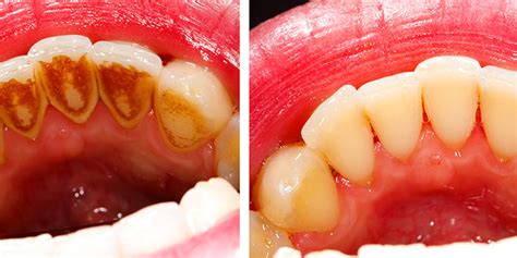 Calculus Teeth Before And After