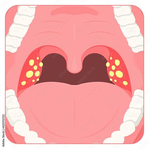 Tonsil Stones Crypts Viral Virus Gland Strep Throat Sore Enlarged Lymph