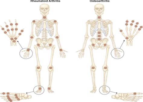 Rheumatoid Arthritis Flashcards Quizlet