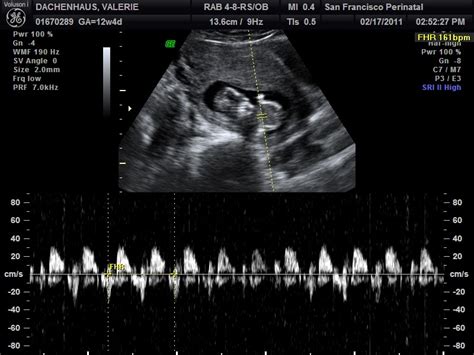 The Dachenhaus Family: Nuchal Translucency Ultrasound