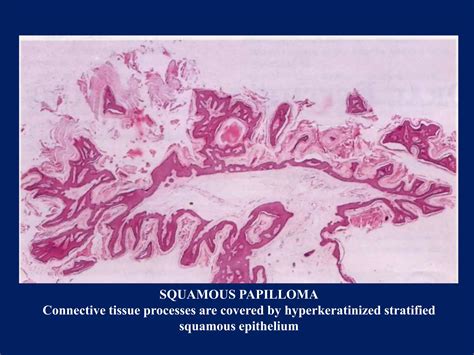 Benign Tumors Of Epithelial Origin Of Oral Cavity PPT