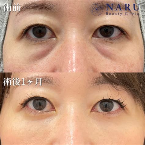 30代女性【目の下の切らないクマ・たるみ取り】【ヒアルロン酸】no58 二重整形専門のnaru Beauty Clinicナルクリ