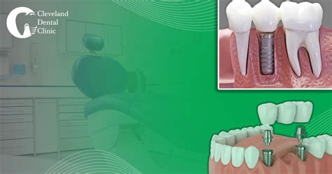 Advantages Of Dental Implants Cleveland Dental Clinic