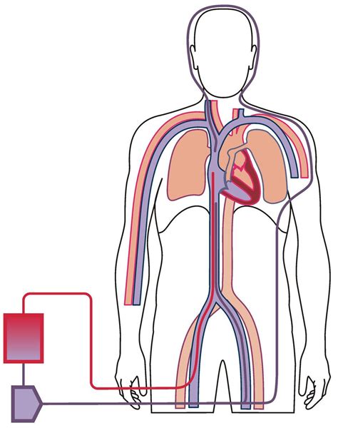 Configurations of ECMO – Alfred ECMO Guideline