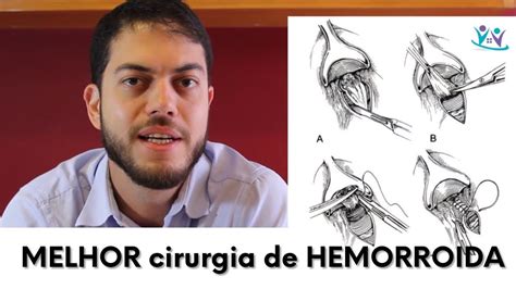 Quais S O As Cirurgias De Hemorroidas Dr Marcelo Werneck Youtube