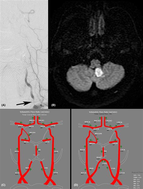 Vertebral Artery Dissection Mri