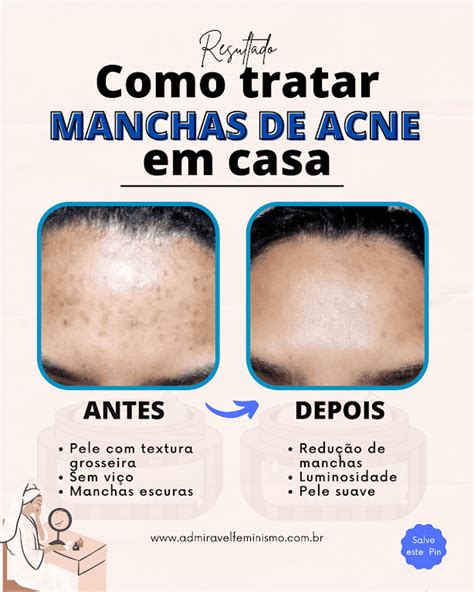 Tamirys Barros Beauty Como Tratar Manchas De Acne Em Casa