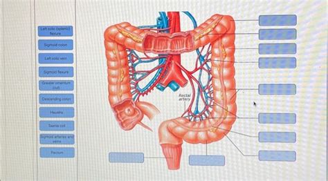 Solved Left Colic Splenic Flexure Sigmoid Colon Left Colic