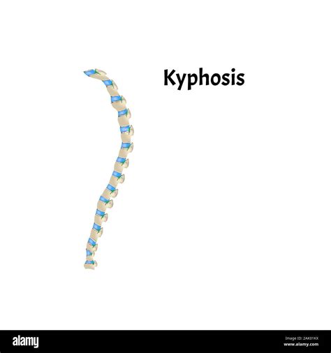 The Position Of The Spine With Kyphosis Spinal Curvature Kyphosis Lordosis Scoliosis