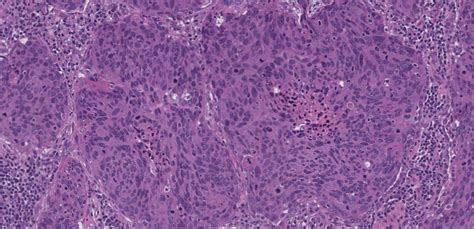 Basaloid Squamous Cell Carcinoma Of The Lung Ottawa Atlas Of Pathology