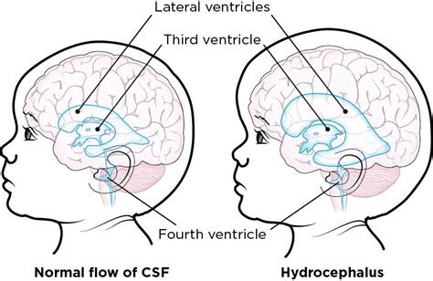 About Hydrocephalus for Pediatric Patients | Memorial Sloan Kettering Cancer Center