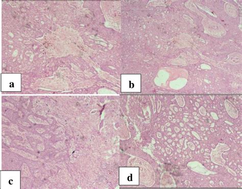 Figure 1 From An Unusual Case Of Basal Cell Carcinoma In The Scrotum