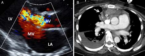 A Echocardiography Demonstrating Severe Aortic Regurgitation B Download Scientific Diagram