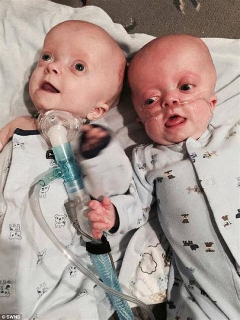 Nurse Adopts Twins With Pfeiffer Syndrome