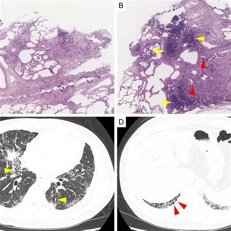 A Case In Which The Pathology Diagnosis By Transbronchial Lung