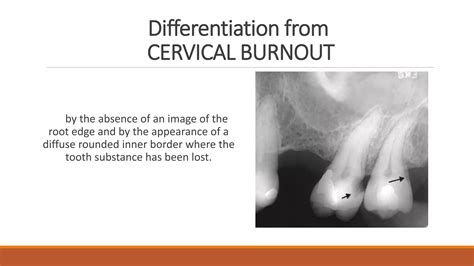 Radiographic Of Interpretation Of Dental Caries Ppt