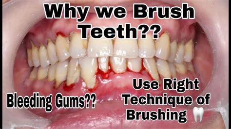 Why We Brush Our Teeth Bleeding Gums Right Brushing Technique To