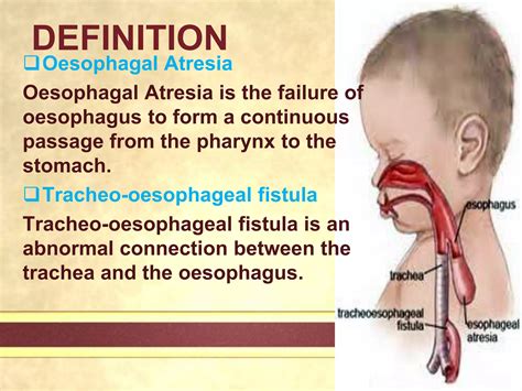 Tracheo Oesophageal Fistula Ppt