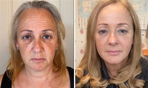 Woman 56 Looks 10 Years Younger After Skin Transformation I Was A