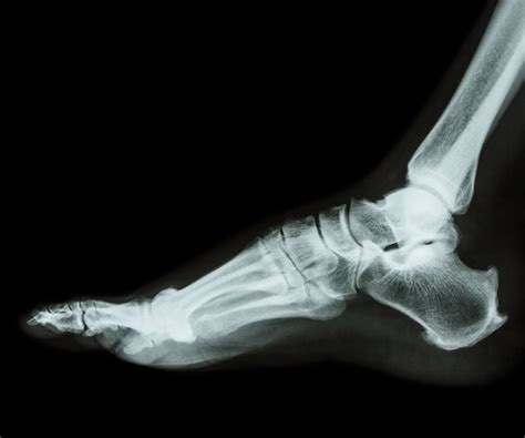 Metatarsal Stress Fracture - Footcare Scotland