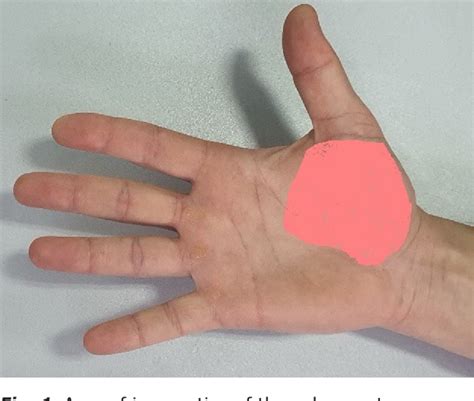 Figure 1 From Clinical Features And Surgical Treatment Of Combination Of Pronator Teres Syndrome