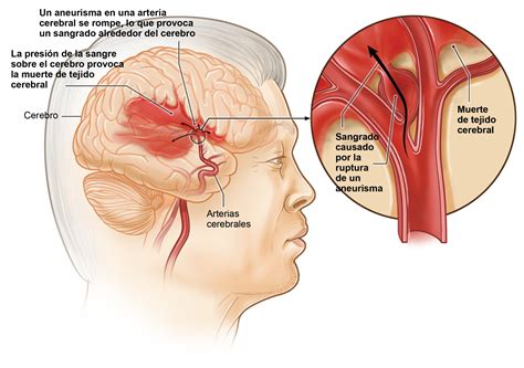 Accidente Cerebrovascular Causas Y Factores De Riesgo Nhlbi Nih