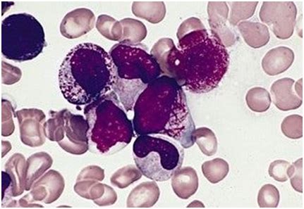 Diagnostic Characterization Of Acute Promyelocytic Leukemia And