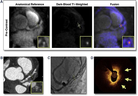 Coronary Atherosclerosis T1 Weighed Characterization With Integrated