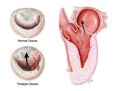 Mitral Valve Prolapse, Panic Attacks & Anxiety