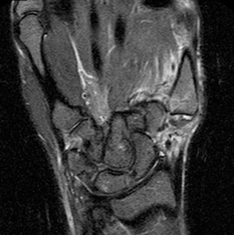 First Carpometacarpal Joint Anatomy - Anatomy Reading Source