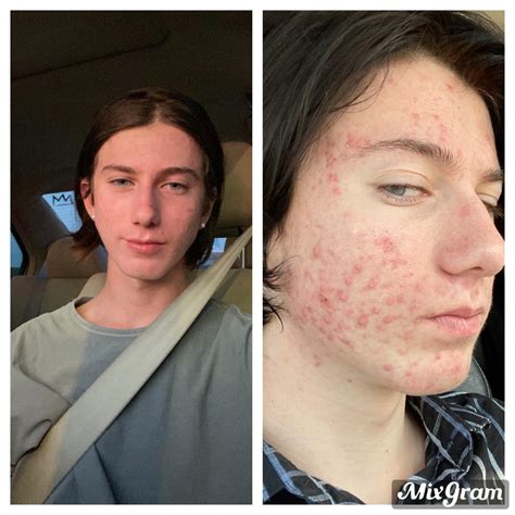 4 months on accutane! before and after:) : r/acne