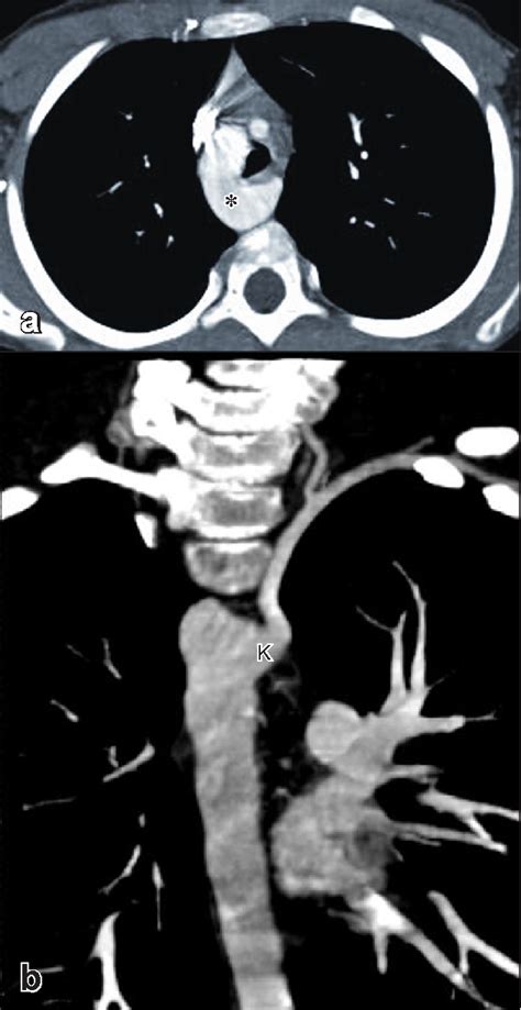 Figure 2 From MDCT Angiography Of Right Sided Aortic Arch With Aberrant