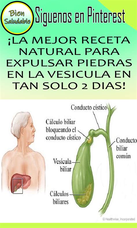 La Mejor Receta Natural Para Expulsar Piedras En La Vesicula En Tan