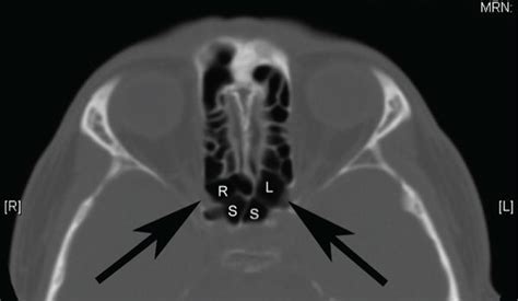 An Example Of Bilateral Sphenoethmoidal Cells That Meet The Criteria Of