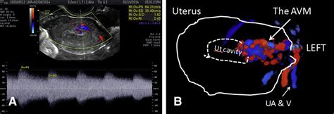 Ultrasound Diagnosis And Management Of Acquired Uterine Enhanced